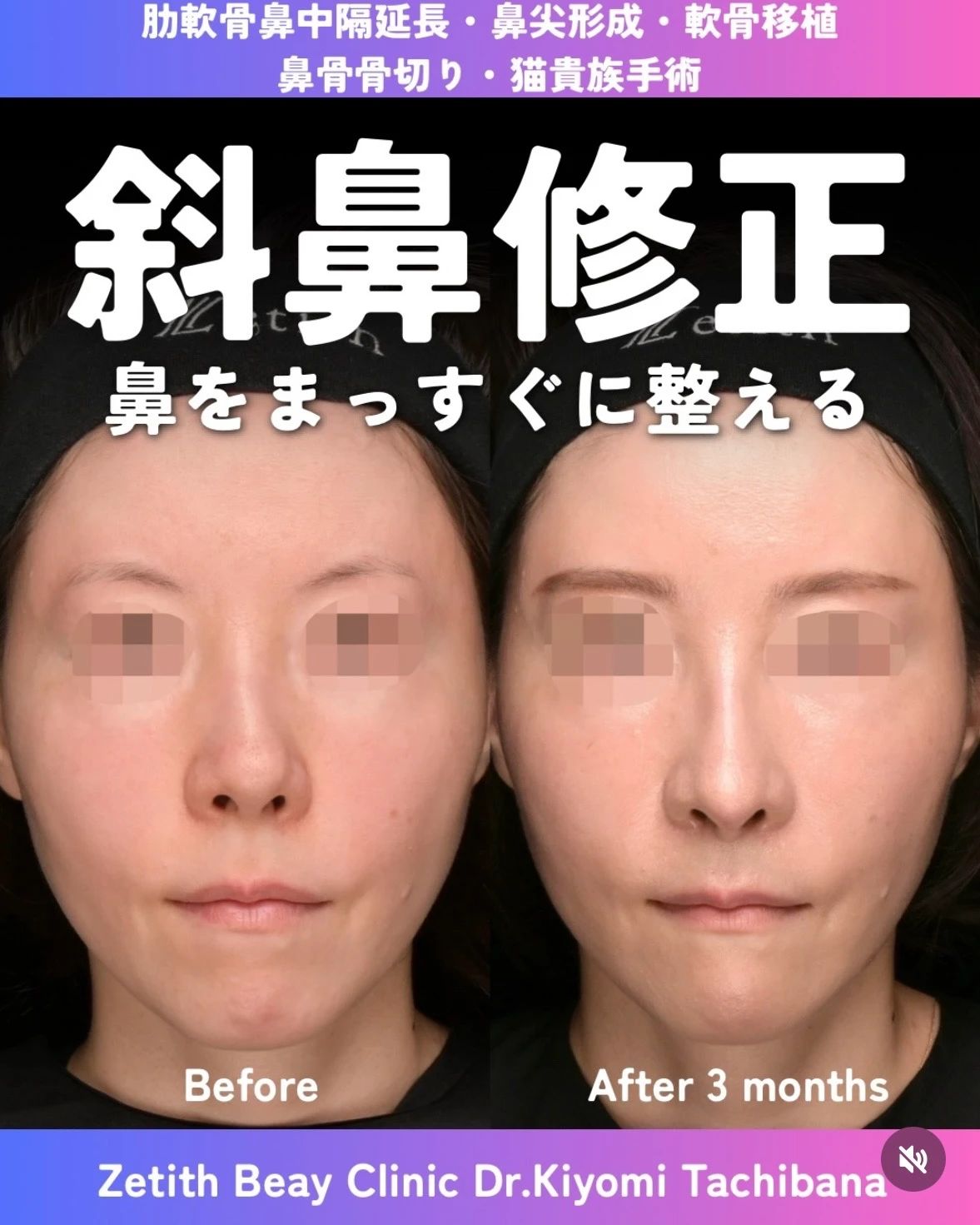 鼻整形 施術前