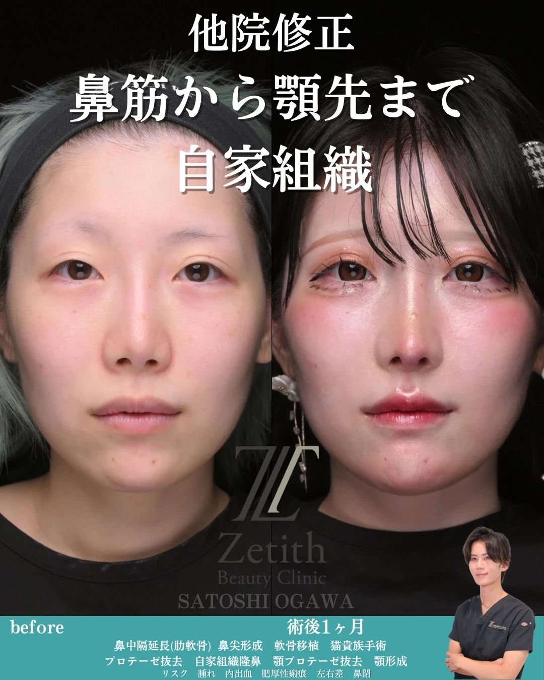 小川医師による鼻整形術前/術後1ヶ月 施術前